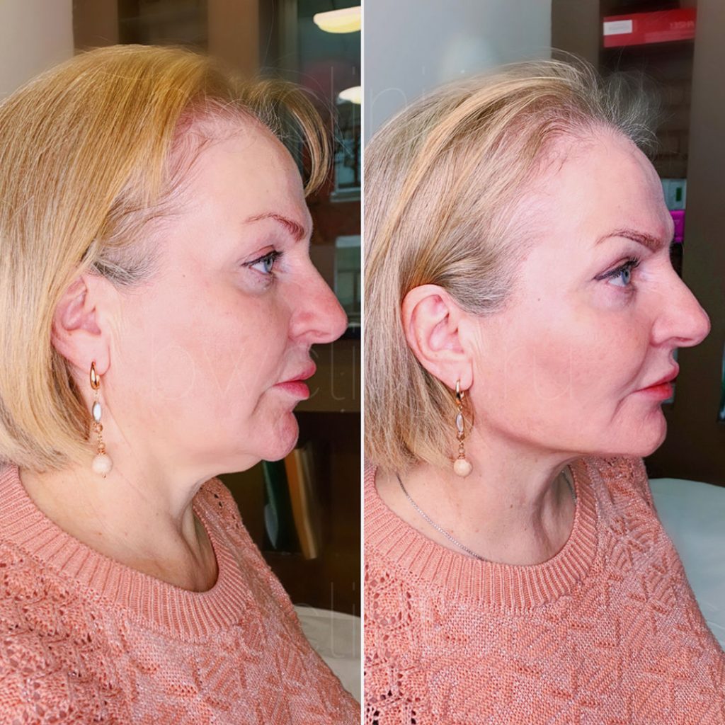 Kybella Before and After: Personal Stories of Transformation